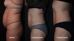 tickle liposuction results