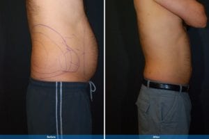 Main Gallery Image 5 | Liposuction Gallery