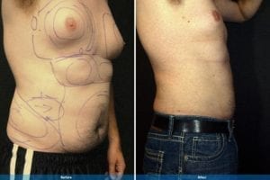 Main Gallery Image 6 | Liposuction Gallery