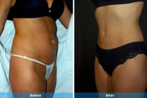 Main Gallery Image 7 | Liposuction Gallery