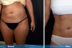 Main Gallery Image 8 | Liposuction Gallery