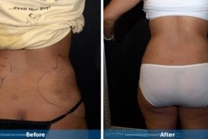 Main Gallery Image 9 | Liposuction Gallery