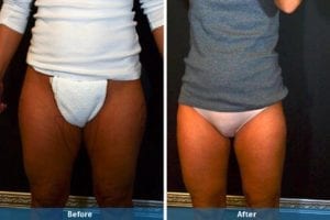 Main Gallery Image 10 | Liposuction Gallery