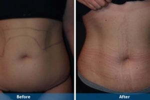 Main Gallery Image 3 | Liposuction Gallery