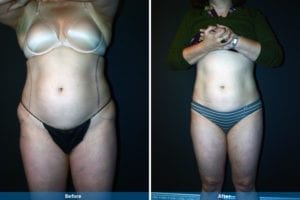 Main Gallery Image 15 | Liposuction Gallery