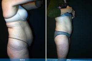 Main Gallery Image 16 | Liposuction Gallery