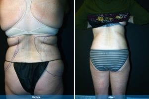 Main Gallery Image 18 | Liposuction Gallery