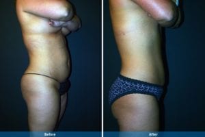 Main Gallery Image 19 | Liposuction Gallery