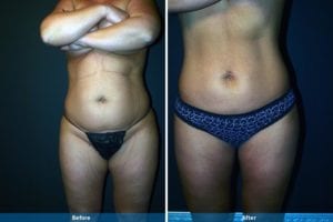 Main Gallery Image 20 | Liposuction Gallery