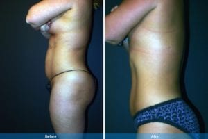 Main Gallery Image 21 | Liposuction Gallery
