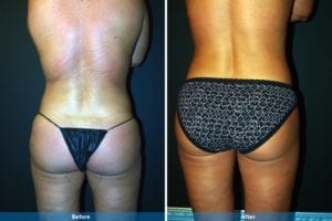 Main Gallery Image 22 | Liposuction Gallery