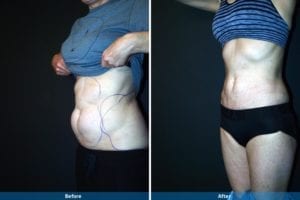Main Gallery Image 23 | Liposuction Gallery
