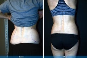 Main Gallery Image 25 | Liposuction Gallery