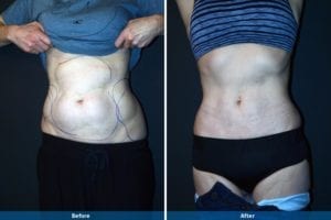 Main Gallery Image 26 | Liposuction Gallery