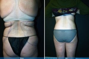 Main Gallery Image 28 | Liposuction Gallery