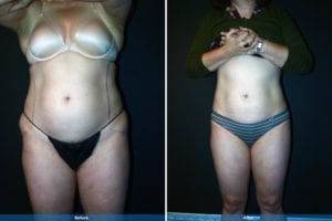 Main Gallery Image 30 | Liposuction Gallery