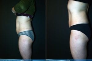 Main Gallery Image 32 | Liposuction Gallery