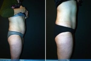 Main Gallery Image 34 | Liposuction Gallery