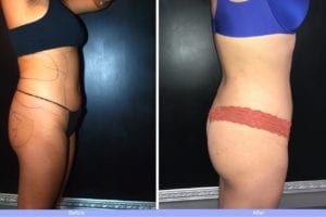 Main Gallery Image 36 | Liposuction Gallery