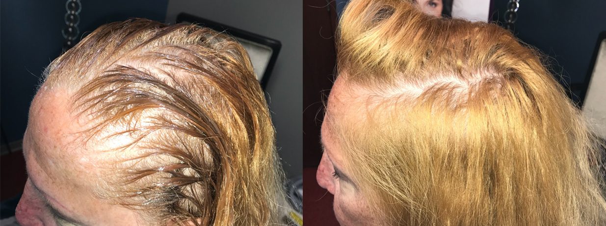 Hair Gallery | Sapphire Advanced Aesthetics Hair Gallery | Sapphire Advanced Aesthetics