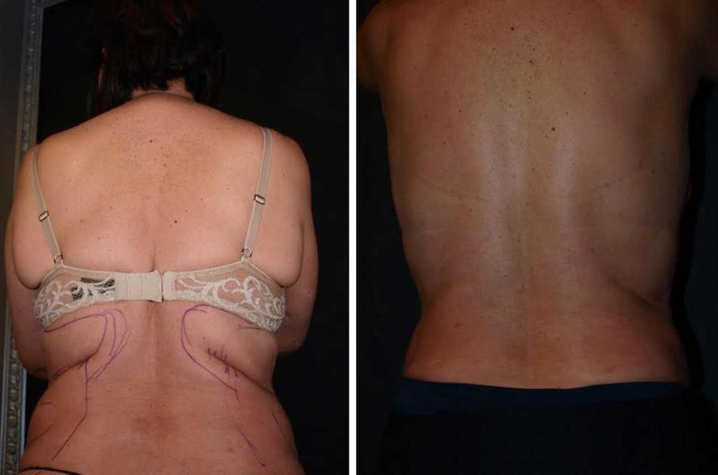 Before and After Awake Tickle of mid Back/ bra-line fat and love handles.  Next day!!! She is thrilled!!!