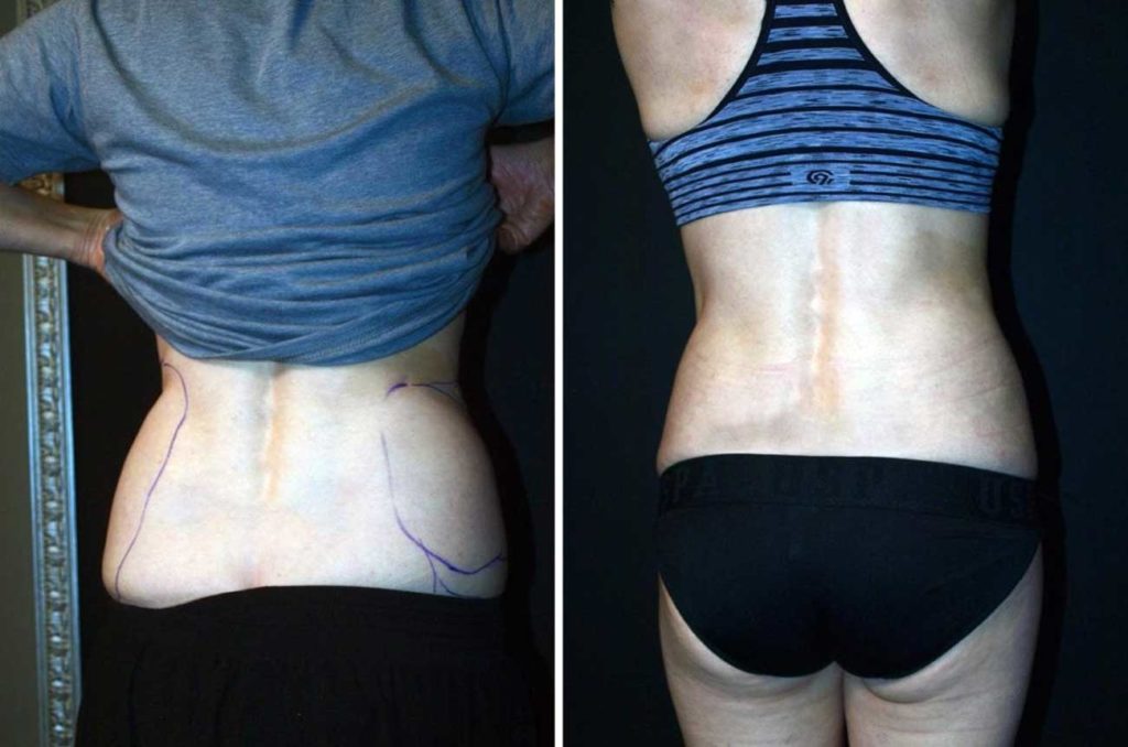 before and after cosmetic surgery