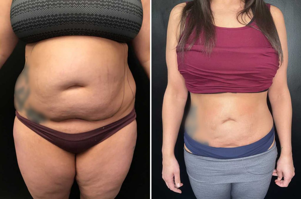 liposuction minneapolis