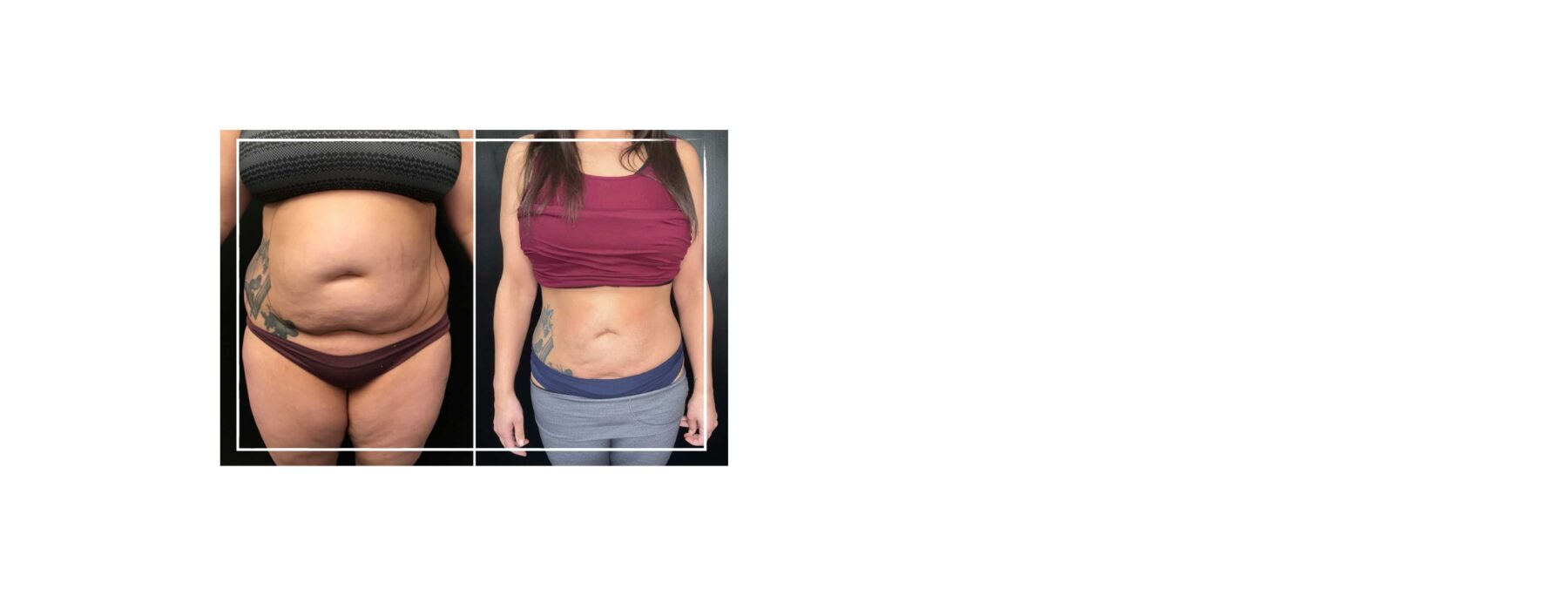 
                    Tickle Lipo + Bodytite