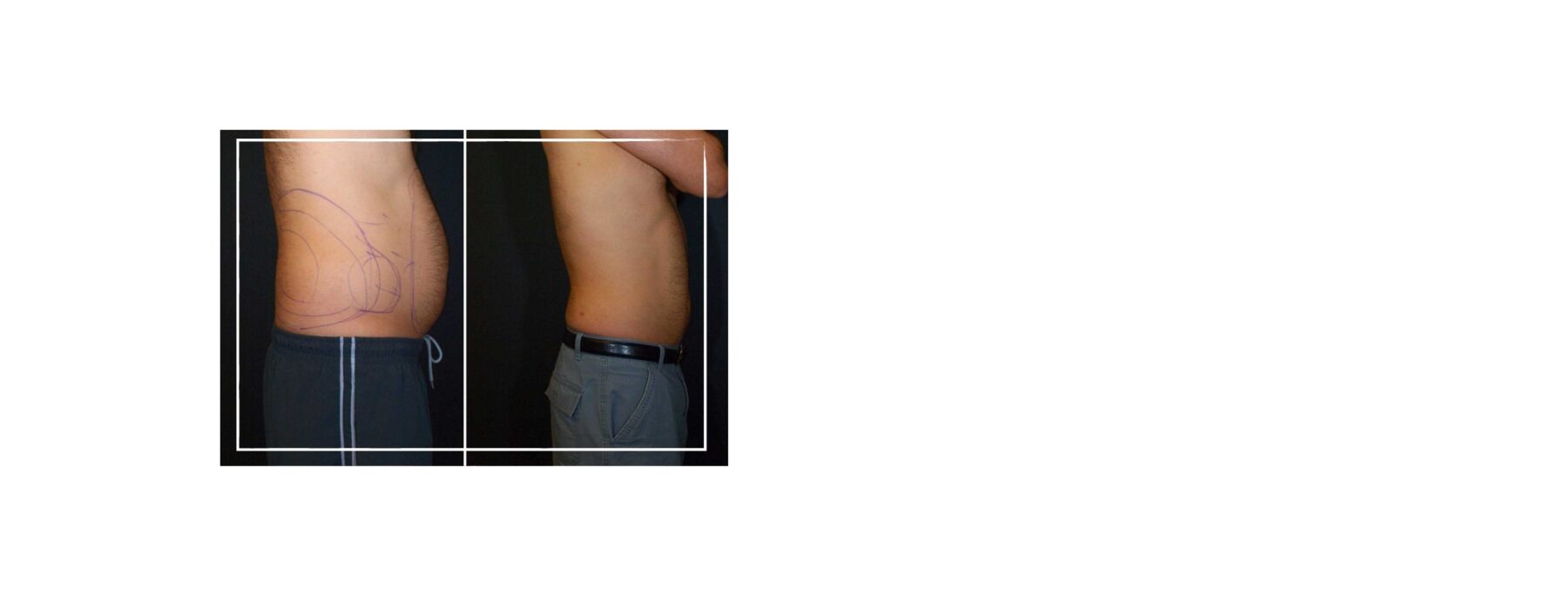 
                    Body Contouring For Men