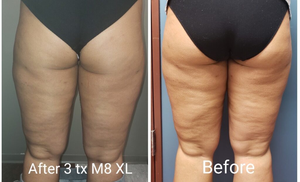 before and after cosmetic surgery