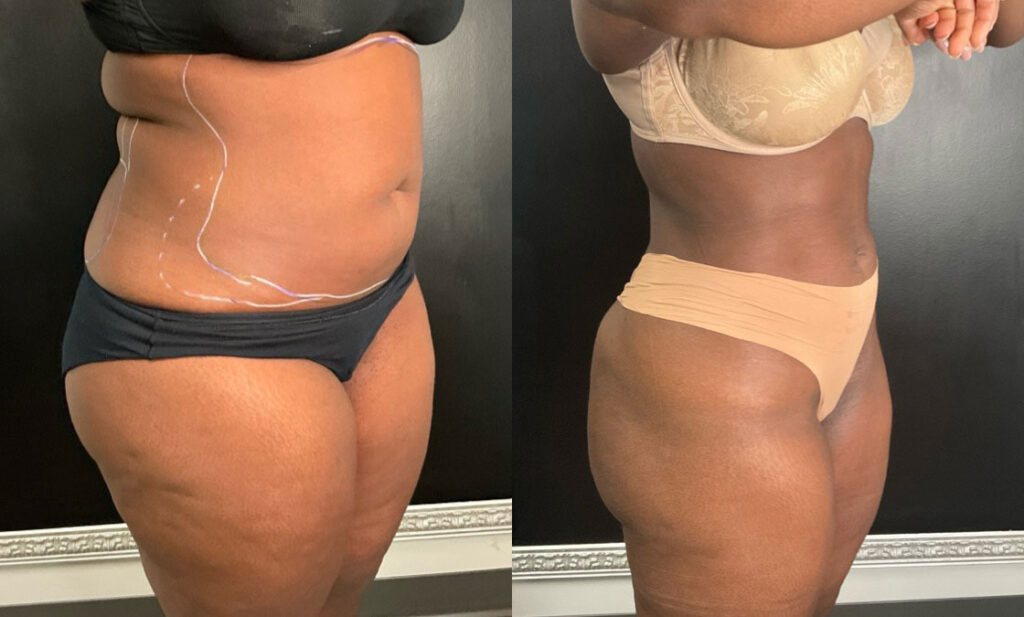 before and after cosmetic surgery