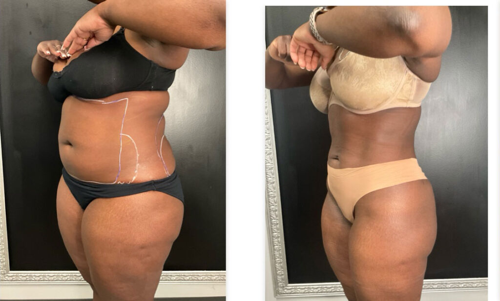 before and after cosmetic surgery