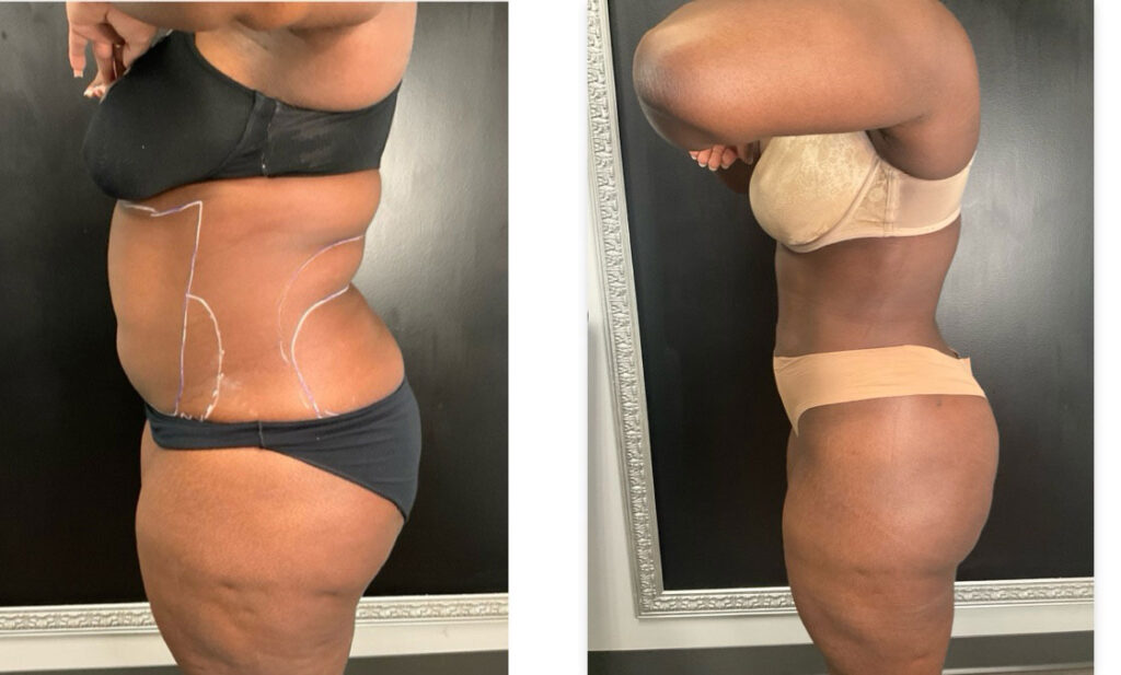 before and after cosmetic surgery