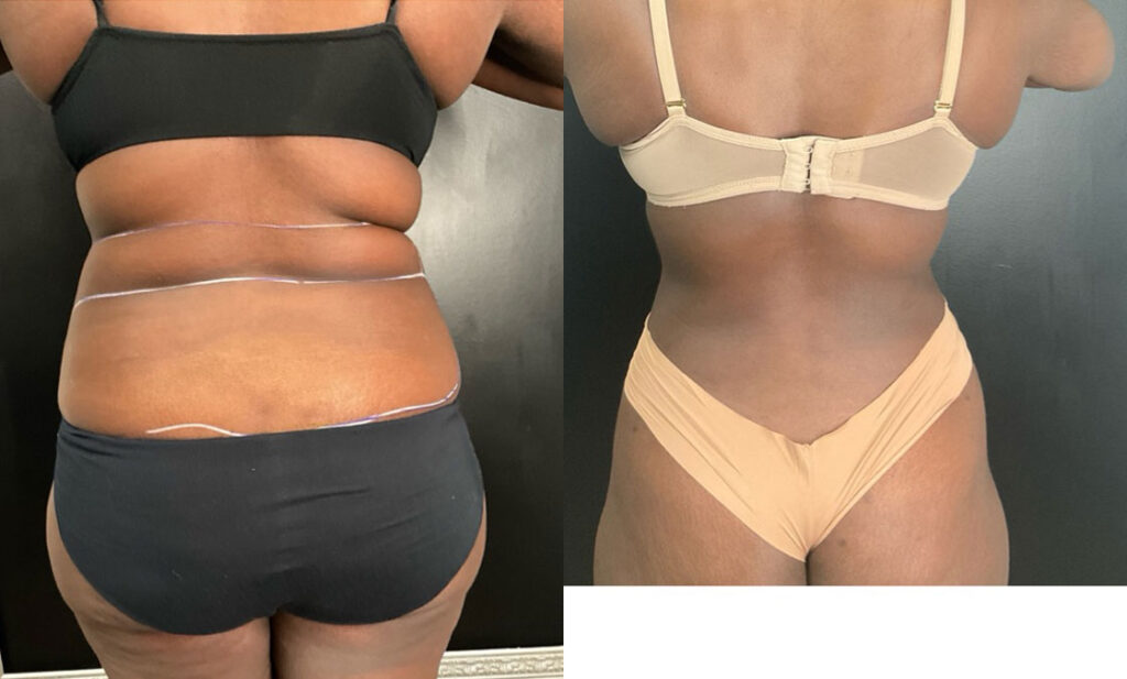 before and after cosmetic surgery