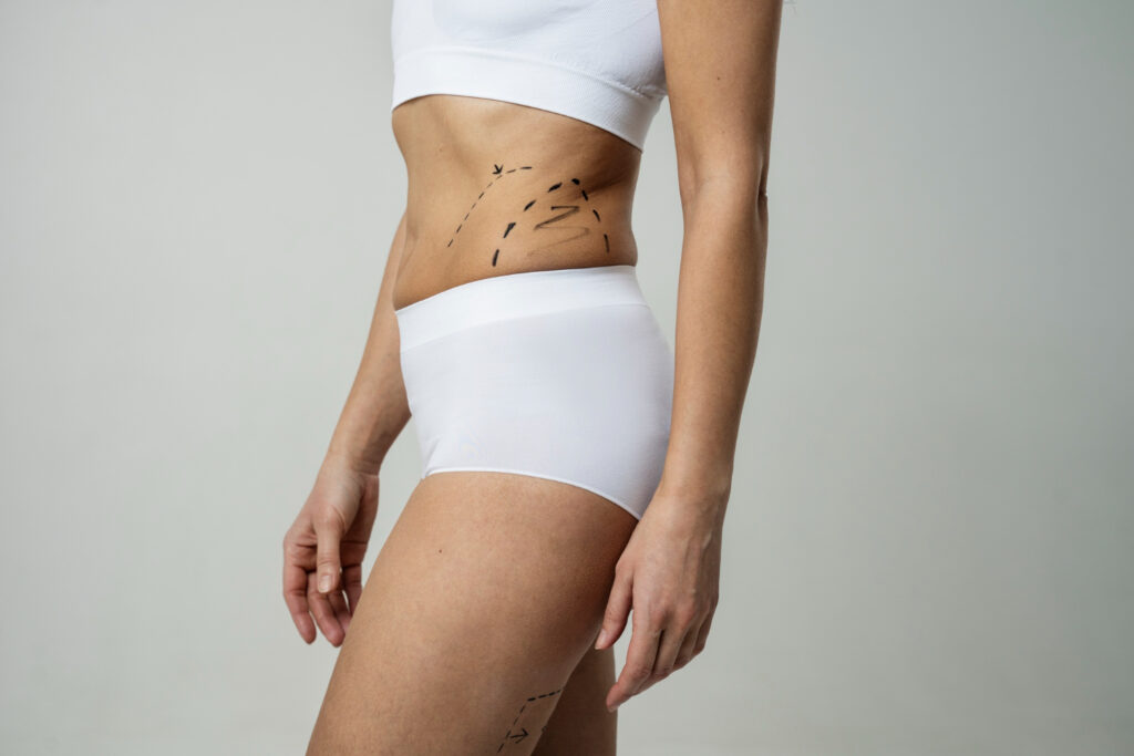 Liposuction