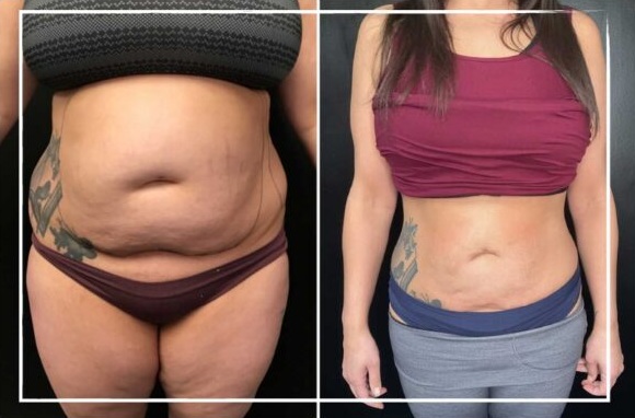 
                    Tickle Lipo + Bodytite