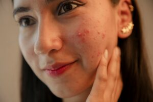 Acne Scars